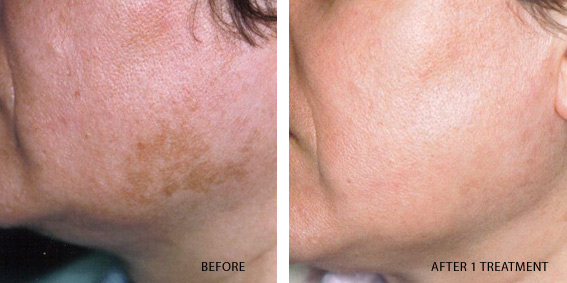 Melasma | American Academy of Dermatology