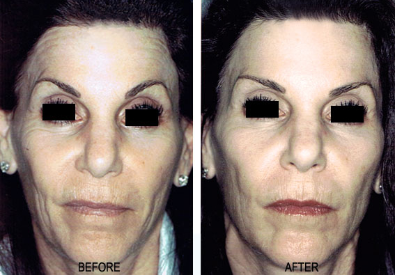 BOTOX® & Dysport® - Crow's Feet