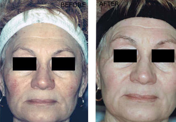Fractional Erbium Yag Laser Mini Peel