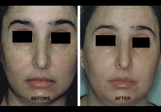 laser treatment for brown spots