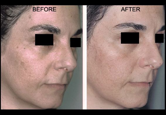 Fractional Erbium Yag Laser Mini Peel