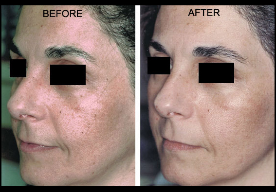 Fractional Erbium Yag Laser Mini Peel