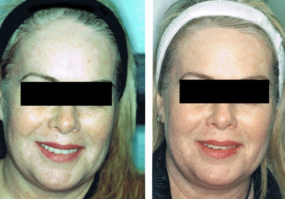 Fractional Erbium Yag Laser Mini Peel