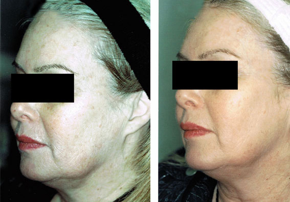 Fractional Erbium Yag Laser Mini Peel