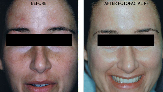 Fotofacial before and after