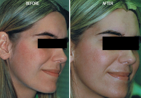 Rosacea Treated by Fotofacial