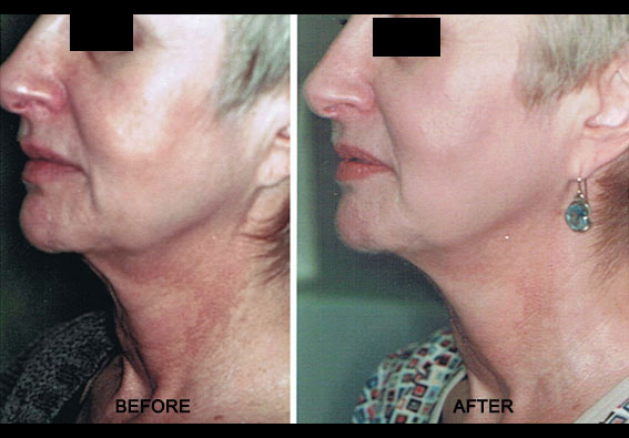 Affirm Multiplex & Refirme Skin Tightening