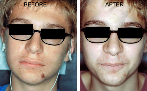 more removal before and after