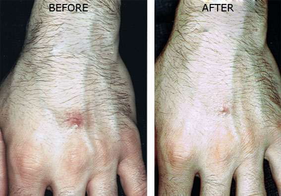 Affirm Multiplex for Scar Treatment