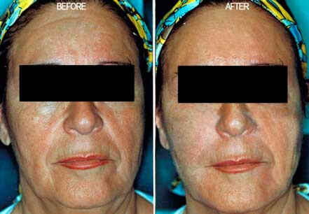 Photo of the patient’s face before and after non-surgical Radiesse dermal filler treatment. Patient 2 - Set 1