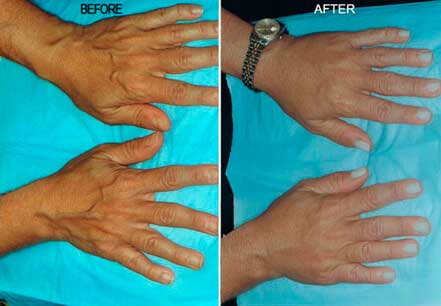 Photo of the patient’s hands before and after non-surgical Radiesse dermal filler treatment. Patient 3 - Set 1