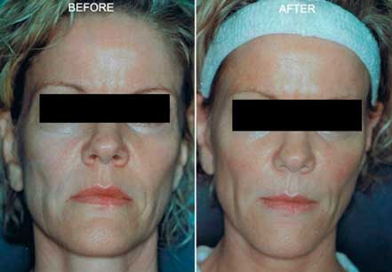 Photo of the patient’s face before and after non-surgical Radiesse dermal filler treatment. Patient 4 - Set 1