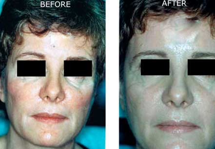 Photo of the patient’s face before and after non-surgical Radiesse dermal filler treatment. Patient 5 - Set 1