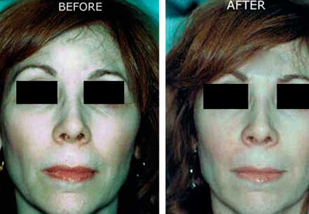 Photo of the patient’s face before and after non-surgical Radiesse dermal filler treatment. Patient 6 - Set 1