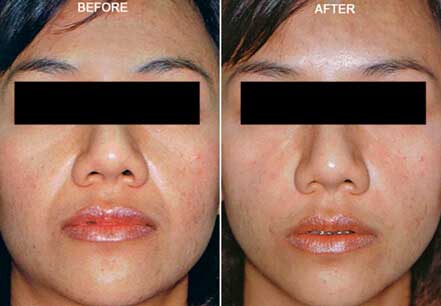 Photo of the patient’s face before and after non-surgical Radiesse dermal filler treatment. Patient 7 - Set 1