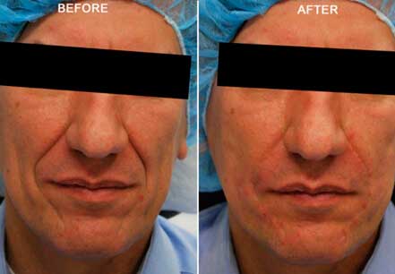 Photo of the patient’s face before and after non-surgical Radiesse dermal filler treatment. Patient 8 - Set 1