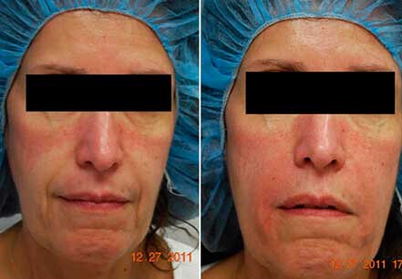 Photo of the patient’s face before and after non-surgical Radiesse dermal filler treatment. Patient 9 - Set 1