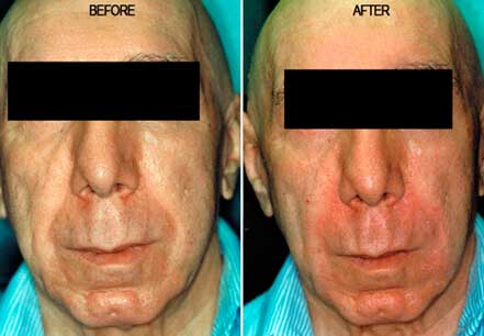 Photo of the patient’s face before and after non-surgical Radiesse dermal filler treatment. Patient 10 - Set 1