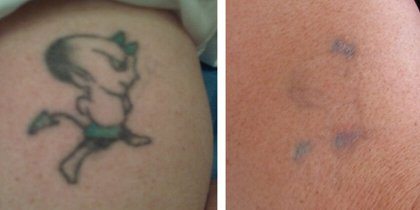 tattoo removal before u0026 after photos nyc tattoo removal before u0026 after photos nyc