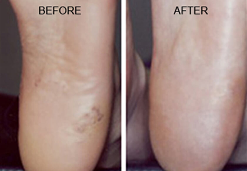 Wart Treatment Before & After Photo Gallery NYC