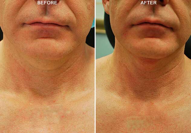 bodyfx figure 8 before and after