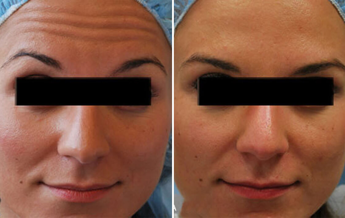 Woman's face, before and after botox injections, front view