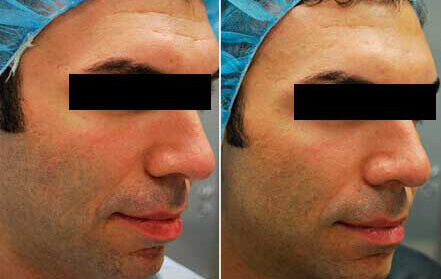 Male face, Before & After acne treatment with Morpheus 8, oblique view, patient 3