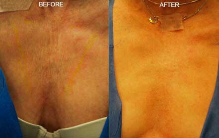 Female decollete, Before & After acne treatment with Morpheus 8, front view, patient 4