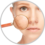 Laser for Acne