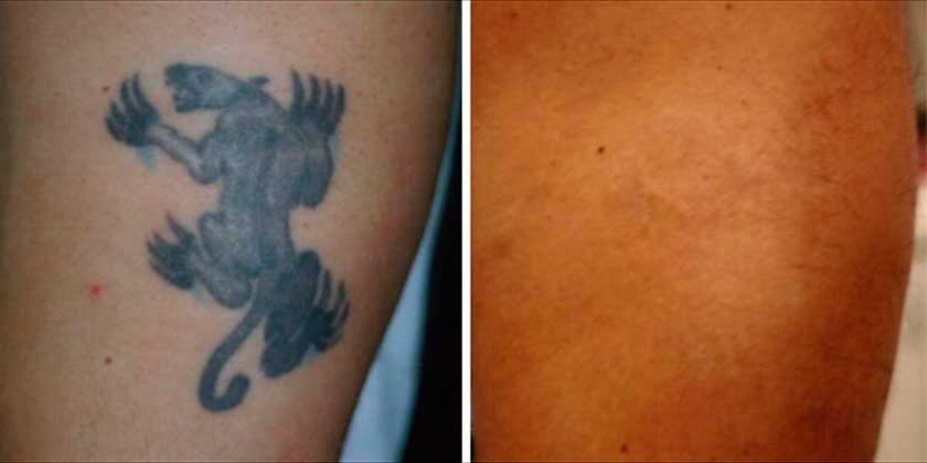 laser tattoo removal new york naturalase qs nyc laser tattoo removal new york naturalase qs nyc