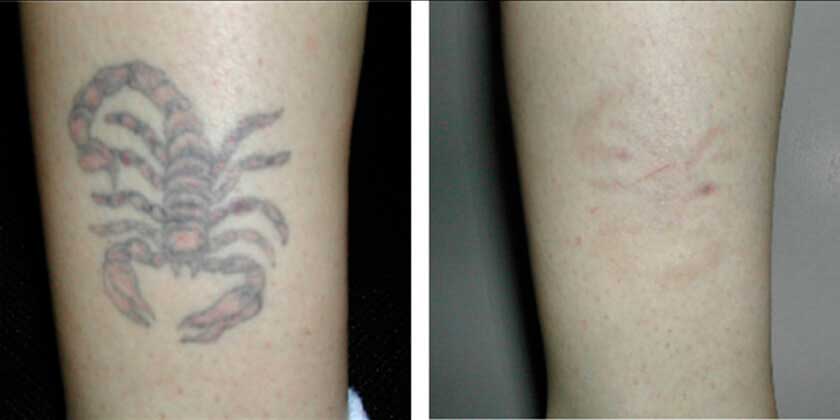 laser tattoo removal new york naturalase qs nyc laser tattoo removal new york naturalase qs nyc