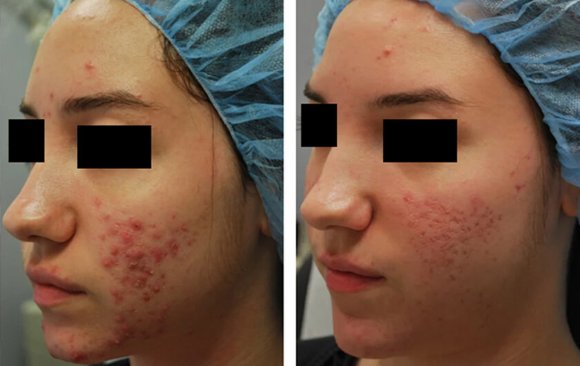 Acne Scars Before &amp; After Photos New York