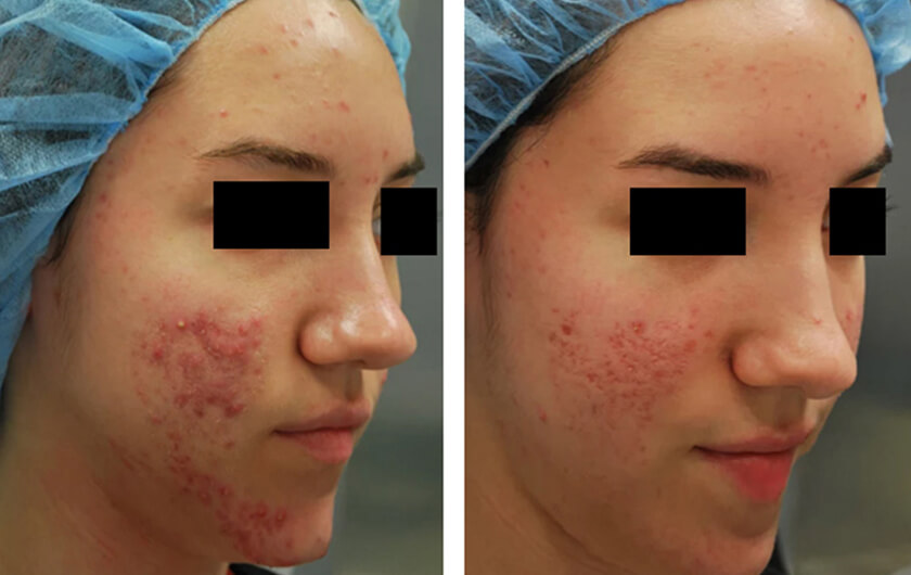 Acne Scars Before &amp; After Photos New York