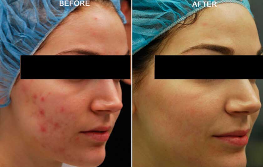 Female face, Before & After acne treatment with Fractora RF, oblique view, patient 2