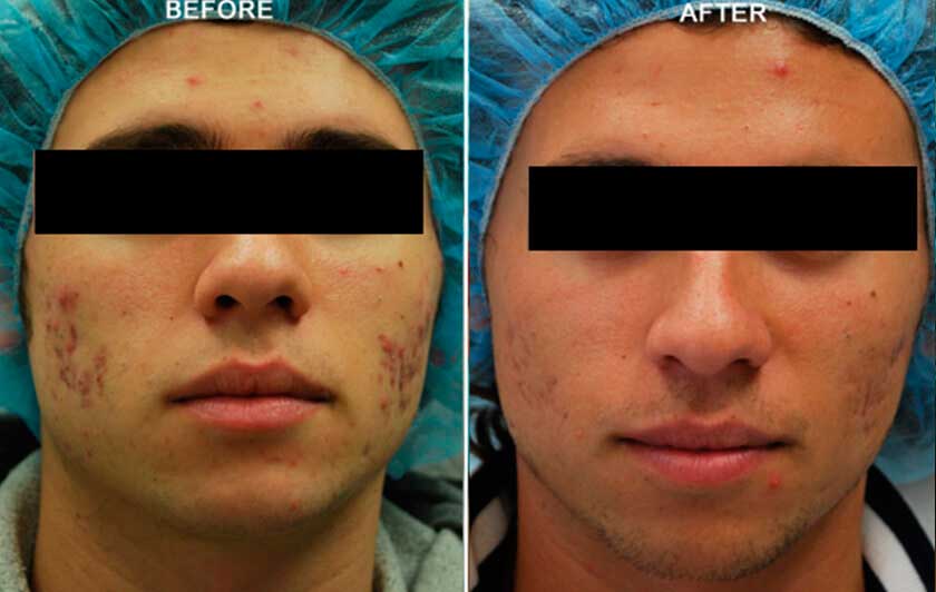 Male face, Before & After acne treatment with Fractora RF, front view, patient 1