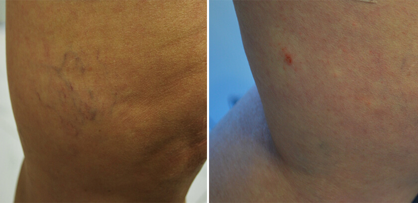 LEG VEIN REMOVAL BEFORE &amp; AFTER PHOTOS