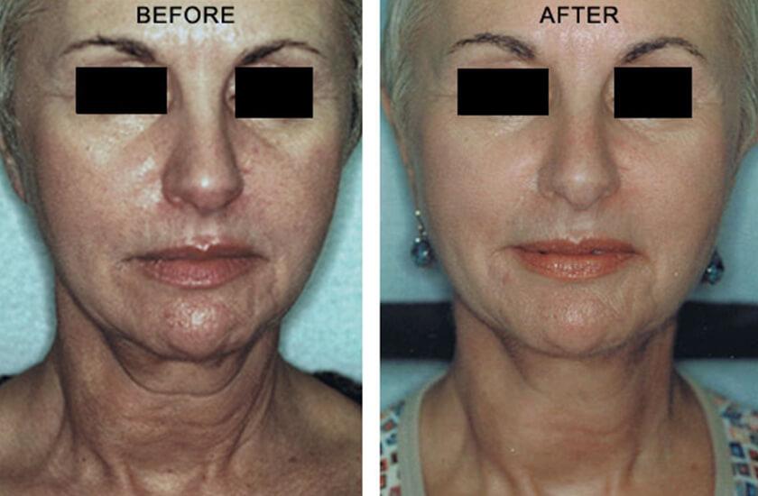 NonSurgical Neck Lift NY Before & After Pictures