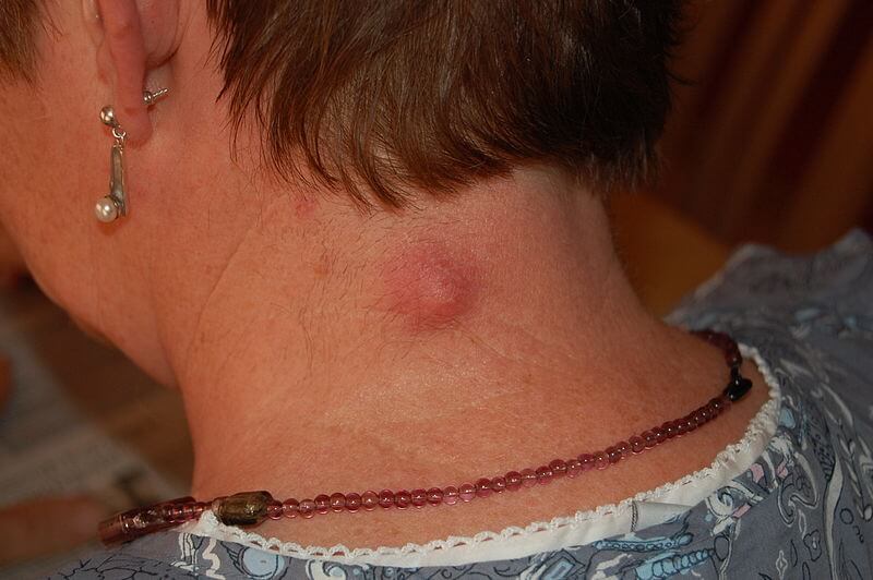 Woman's neck, before and after Cysts treatment, back side view