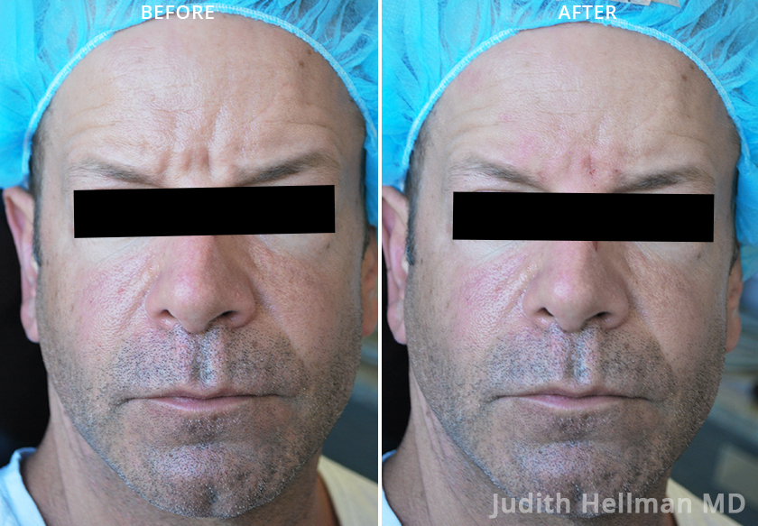 Photo of the patient’s face before and after Restylane & Perlane treatment. Patient 1 - Set 1