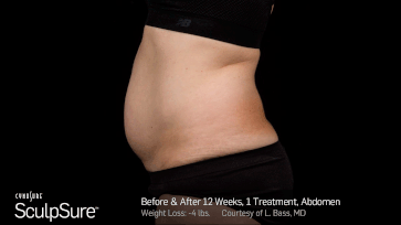 Before and After Photos 12 weeks, 1 Treatment, abdomen (female patient 7, side view)