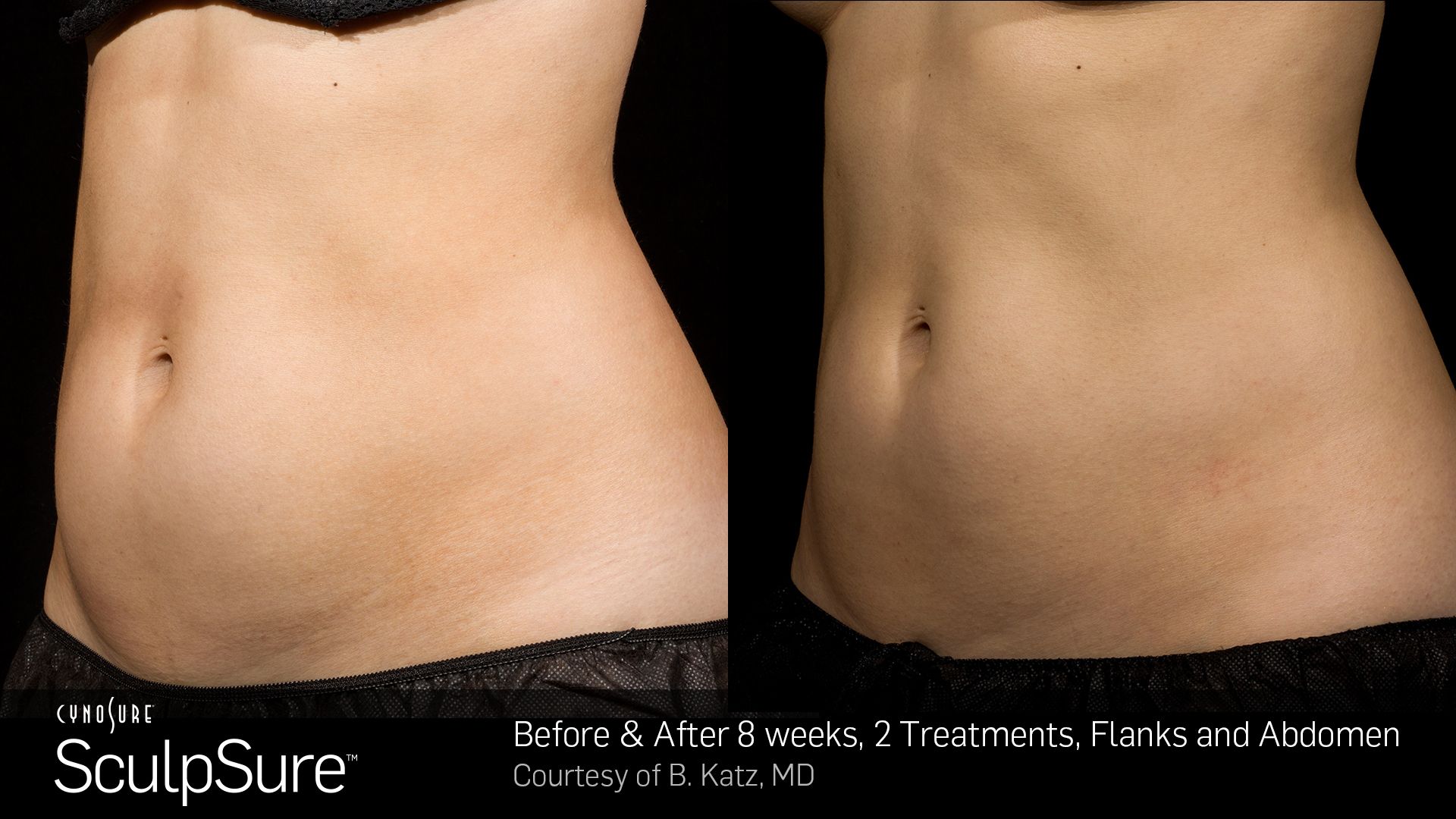 Before and After Photos 8 weeks, 2 Treatment,flanks abdomen (female patient 4, side view)