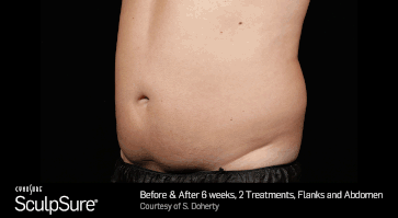 Before and After Photos 6 weeks, 2 Treatment, abdomen (patient 2, oblique view)