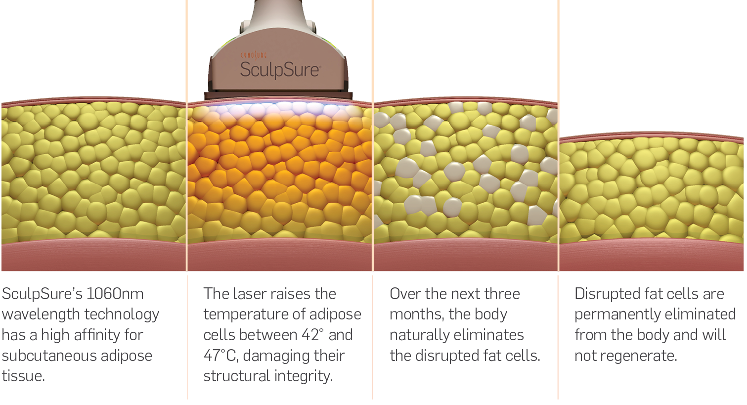 SculpSure works through laser technology