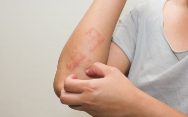 Eczema And Allergic Reactions