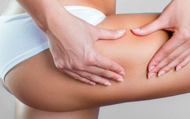 Cellulite Treatment