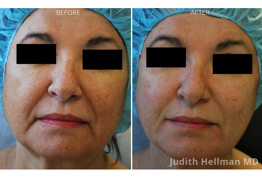 Photo of the patient’s face before and after Restylane & Perlane treatment. Patient 3 - Set 1