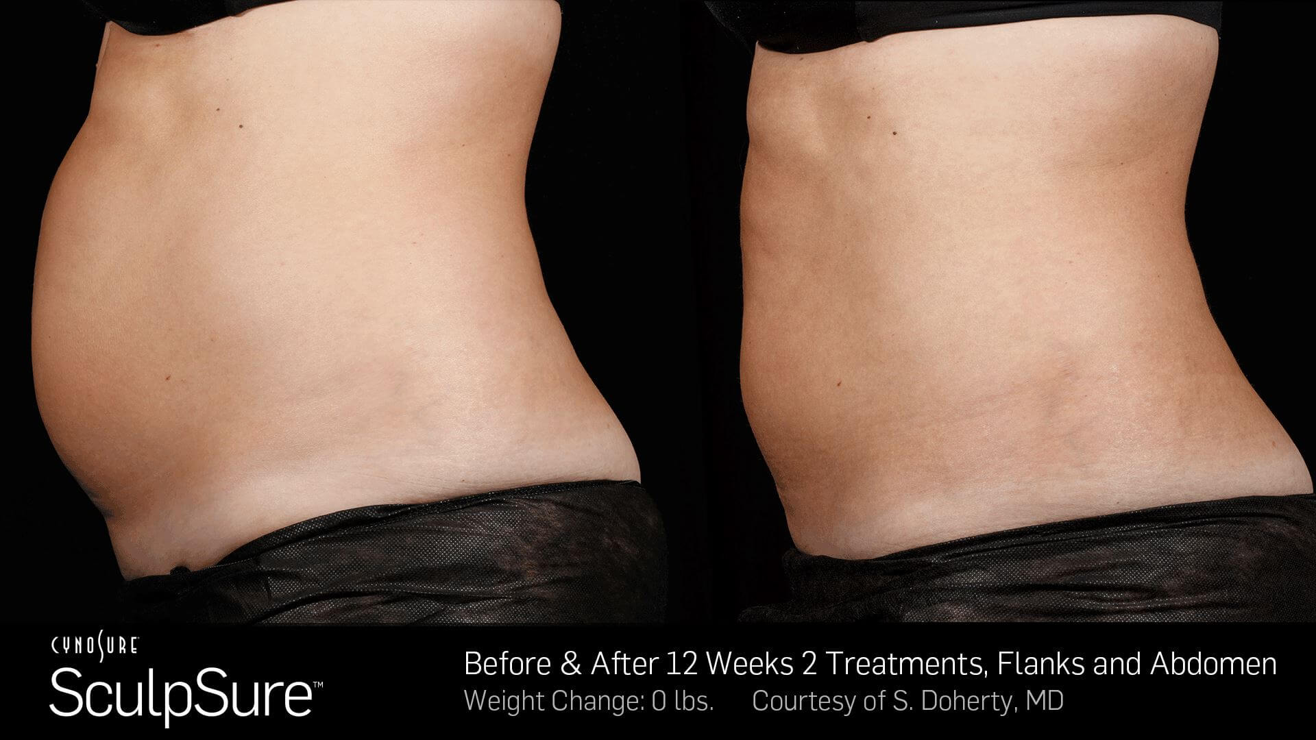 Before and After Photos 12 weeks, 2 Treatment, Flanks and Abdomen (female patient 3, side view)