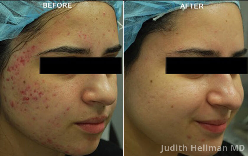 Woman's face, before and after Morpheus8 Treatments, right side oblique view, patient 3