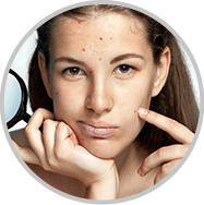 Acne Scars