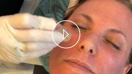 Watch Video - Dr. Judith Hellman explains the benefits of using Aquagold Fine Touch